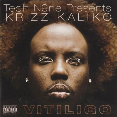 Krizz Kaliko Vitiligo